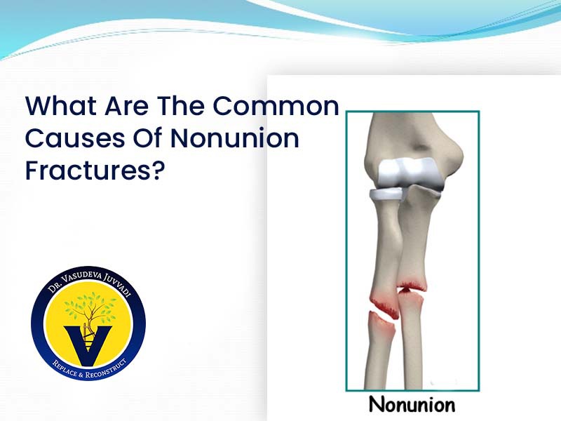 how common are non union fractures