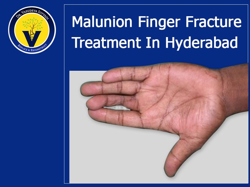 Malunion finger fracture treatment