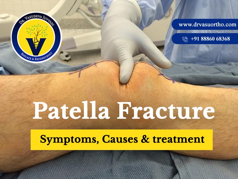 Patella fracture surgery