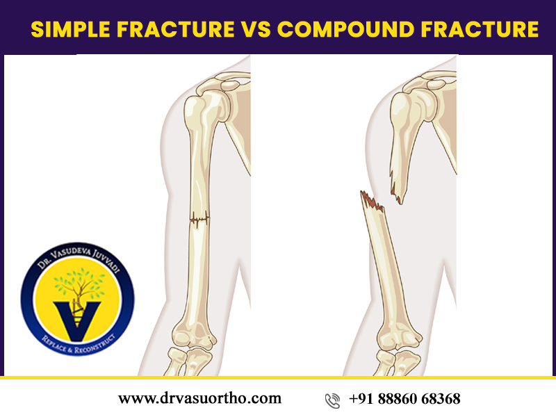 Simple fracture vs compound