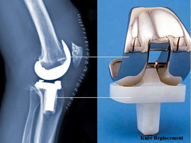 top-5-benefits-of-robotic-knee-replacement